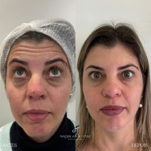 Botox (10)