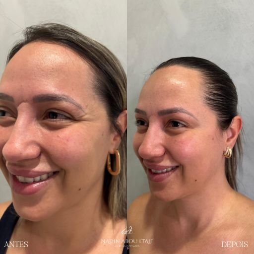 Botox (2)