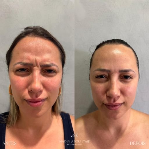 Botox (3)