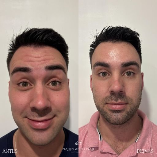 Botox (5)