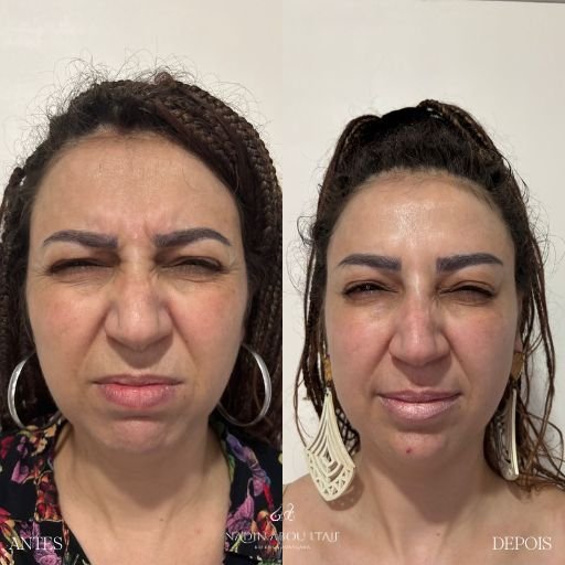 Botox (6)