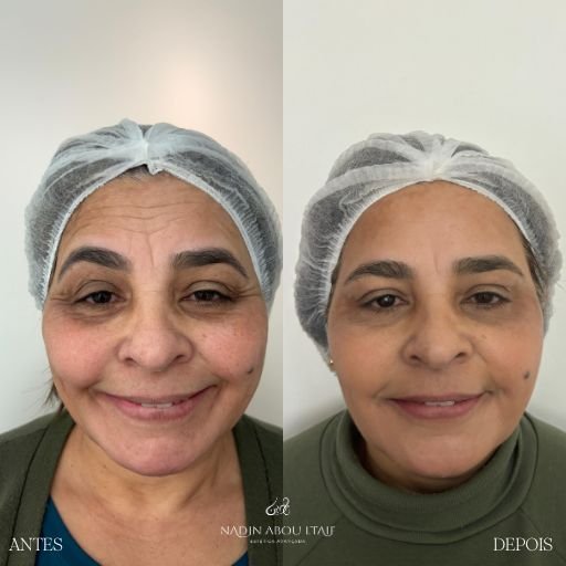 Botox (7)