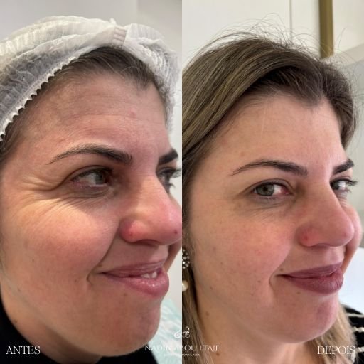 Botox (9)