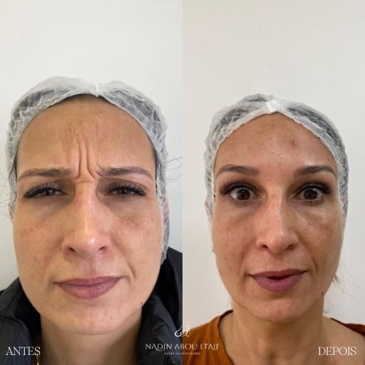 Botox